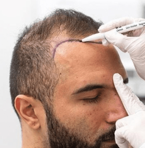 Image18912022 03 03 17 44 22hair Transplant Featured